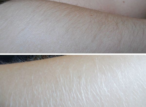 Перекись водорода от нежелательных волос: фото до и после